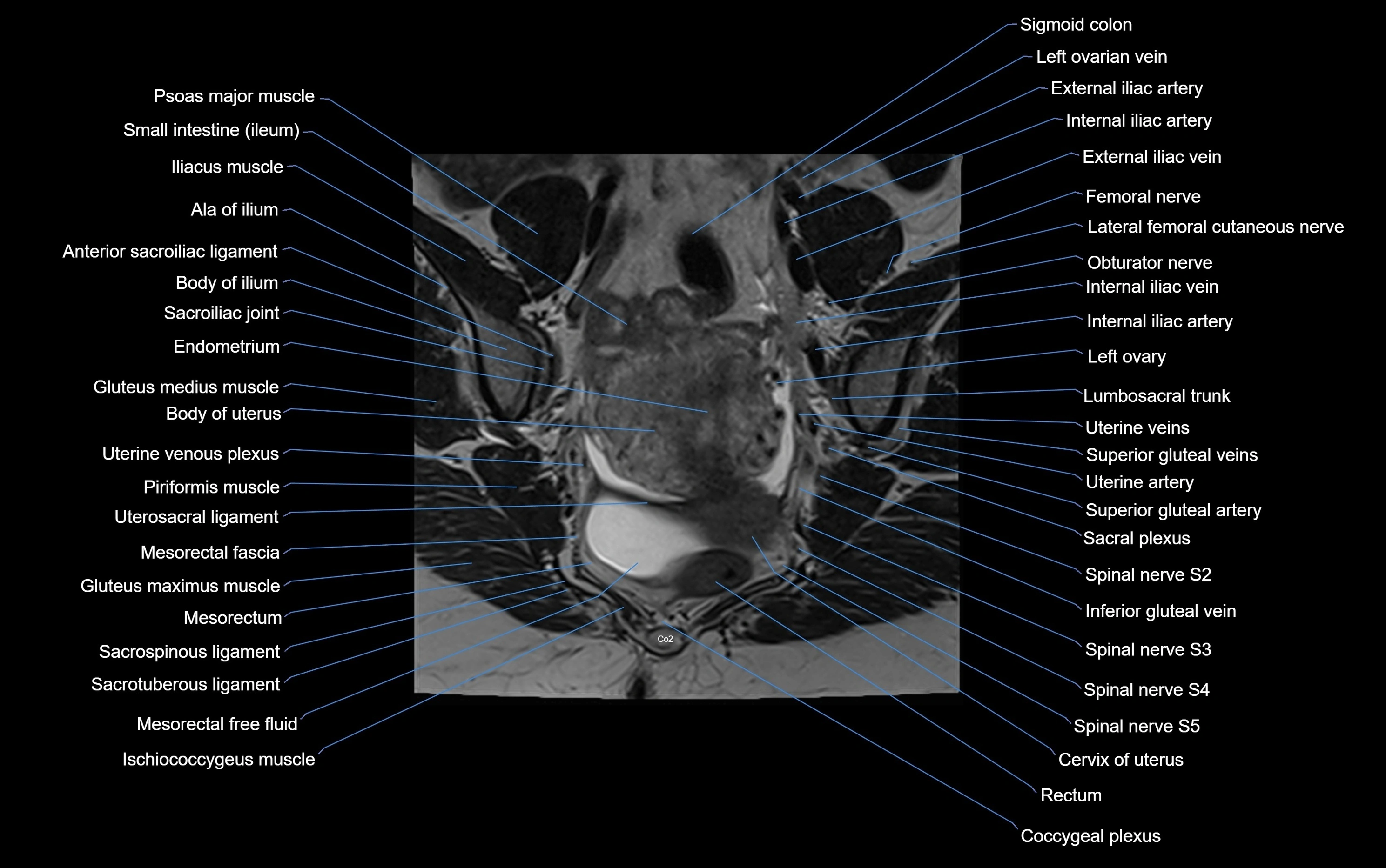 MRI sacroiliac joint coronal cross sectional anatomy  radiology  image-img-00001-00006.webp